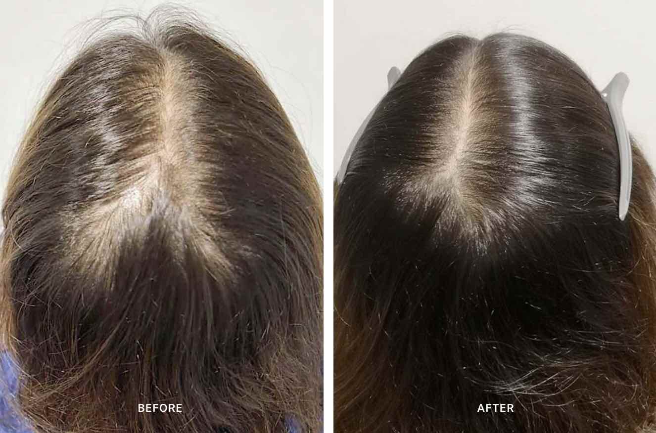 Advanced Hair System (6 Week Program) - Calecim Professional. Before After.