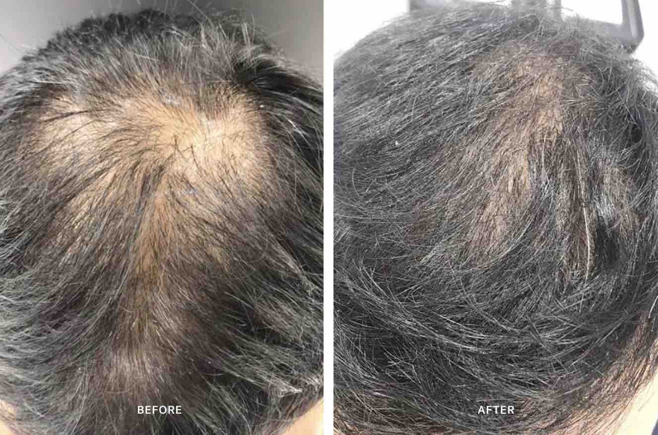 Advanced Hair System (6 Week Program) - Calecim Professional. Before After.