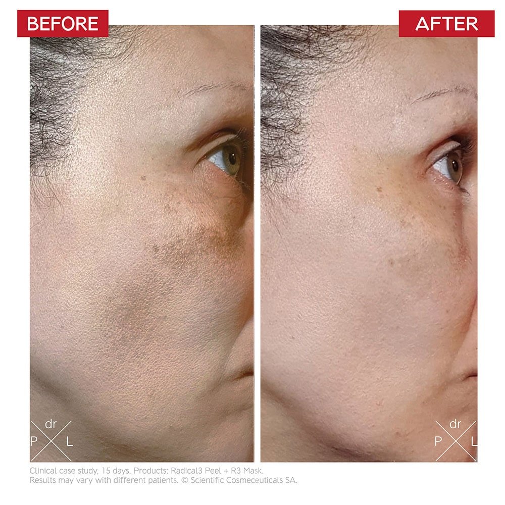 PHYSICAL - Radical3 Reboot Pro Peel - Dr Levy